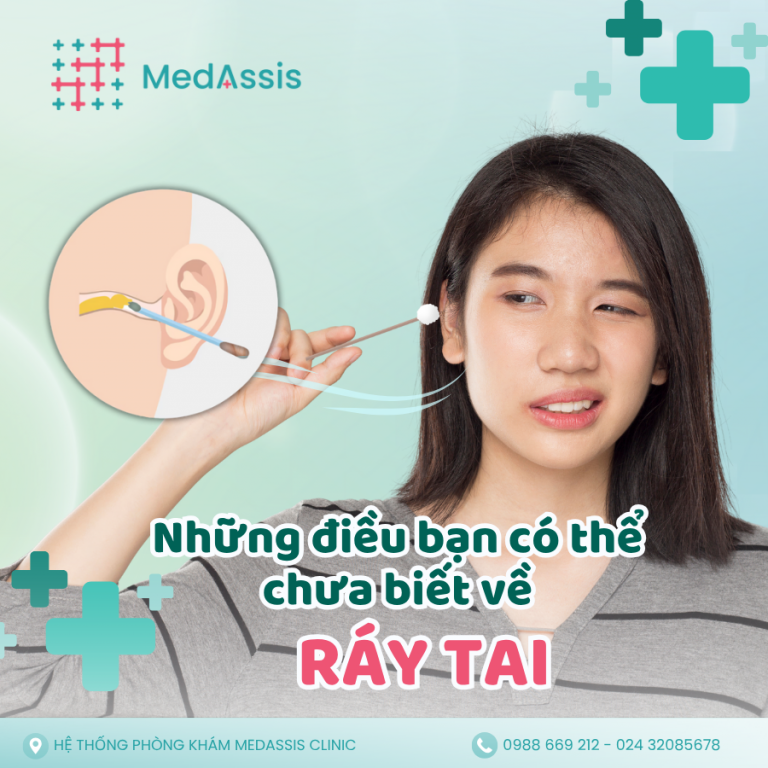 “Ráy tai